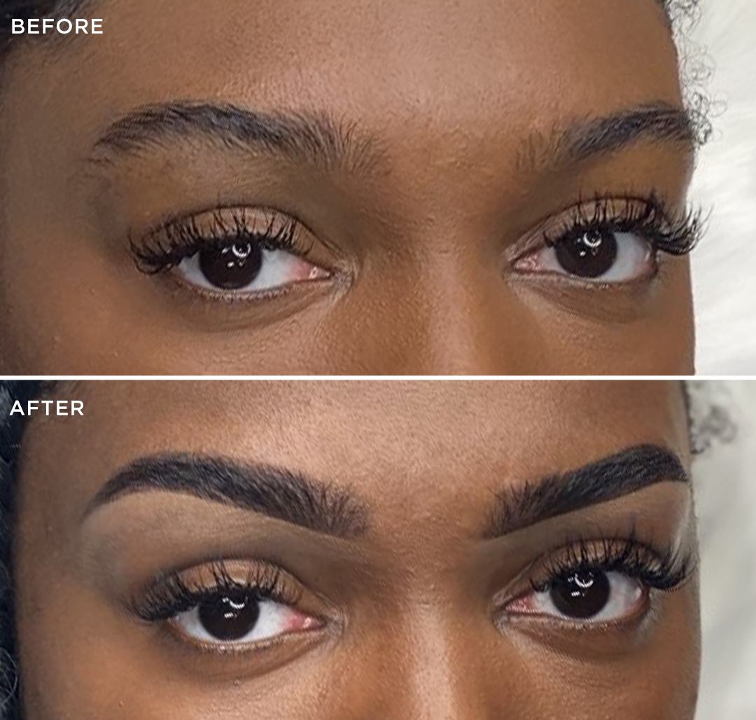 brow lift avant après