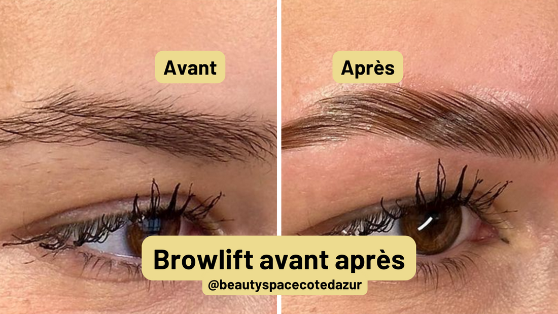 brow lift avant apres