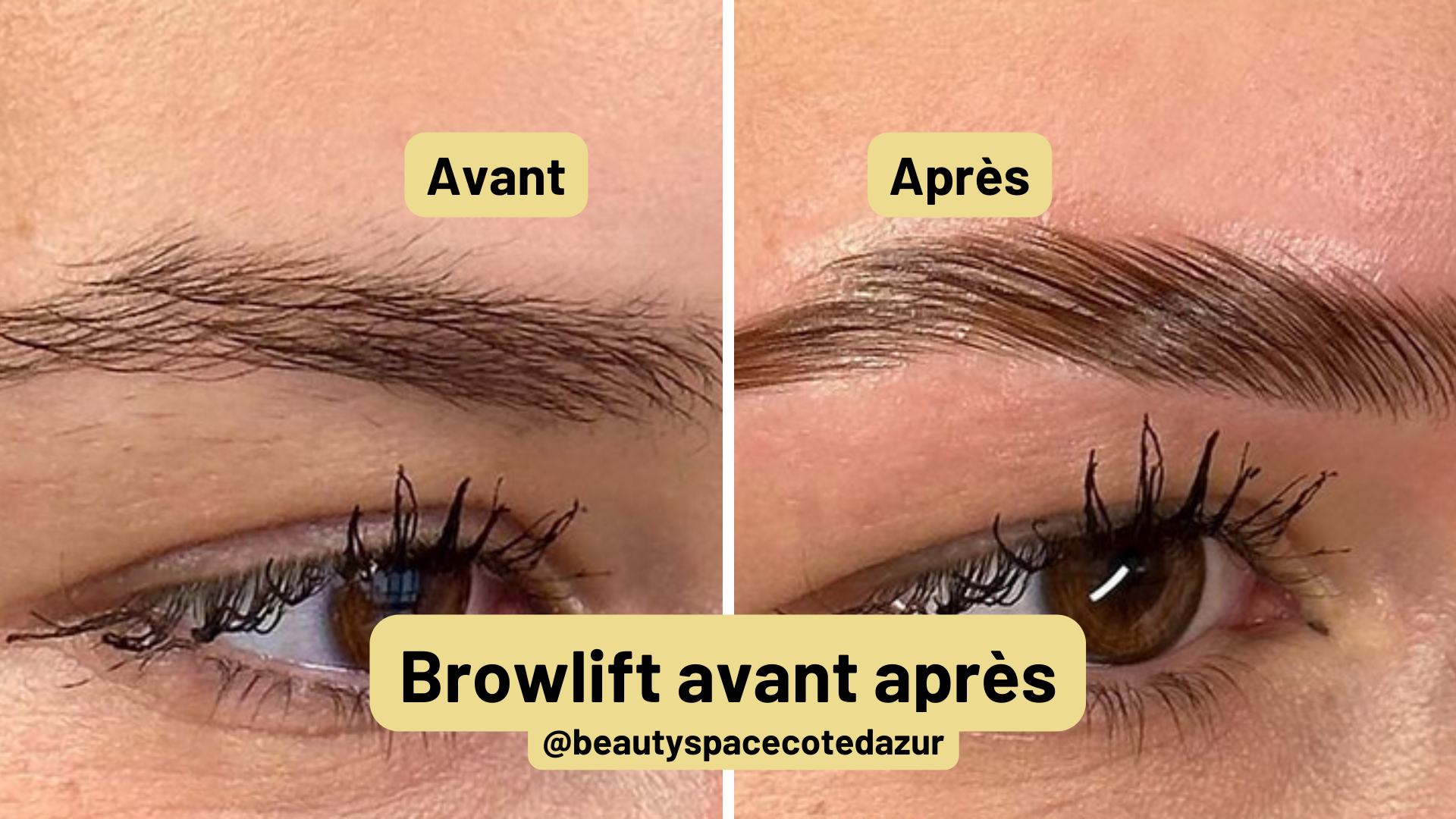 brow lift avant apres