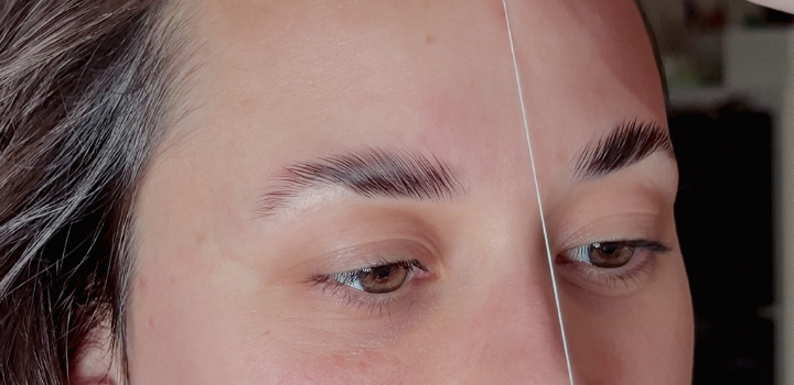 brow lift